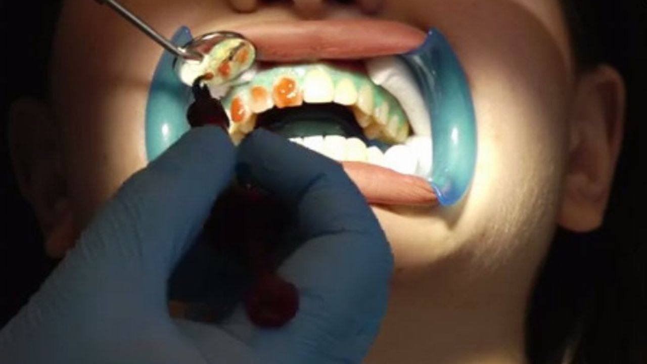Diş beyazlatma dişlere zarar verir mi?